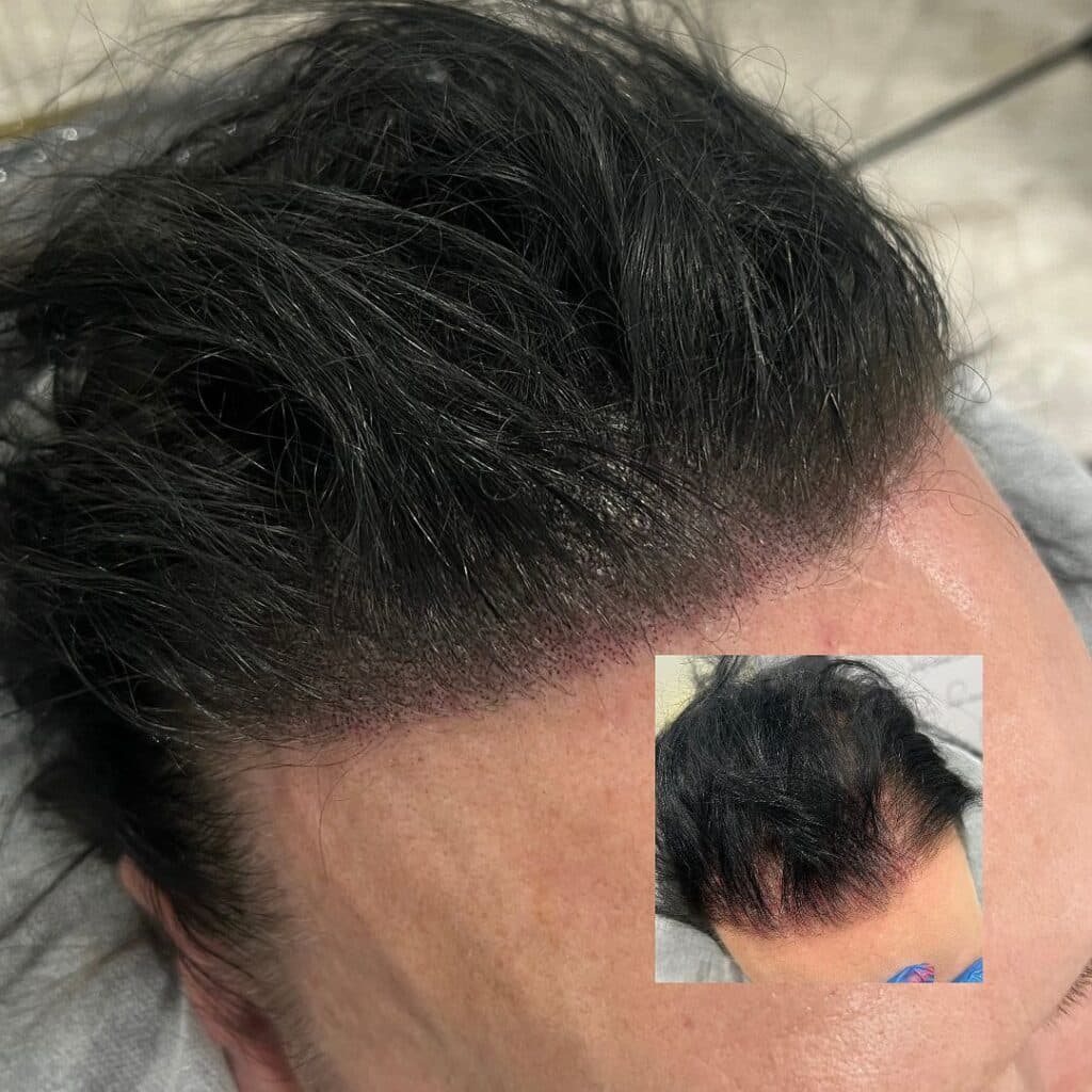 Scalp micropigmentation for thinning hair – before and after results showing added density