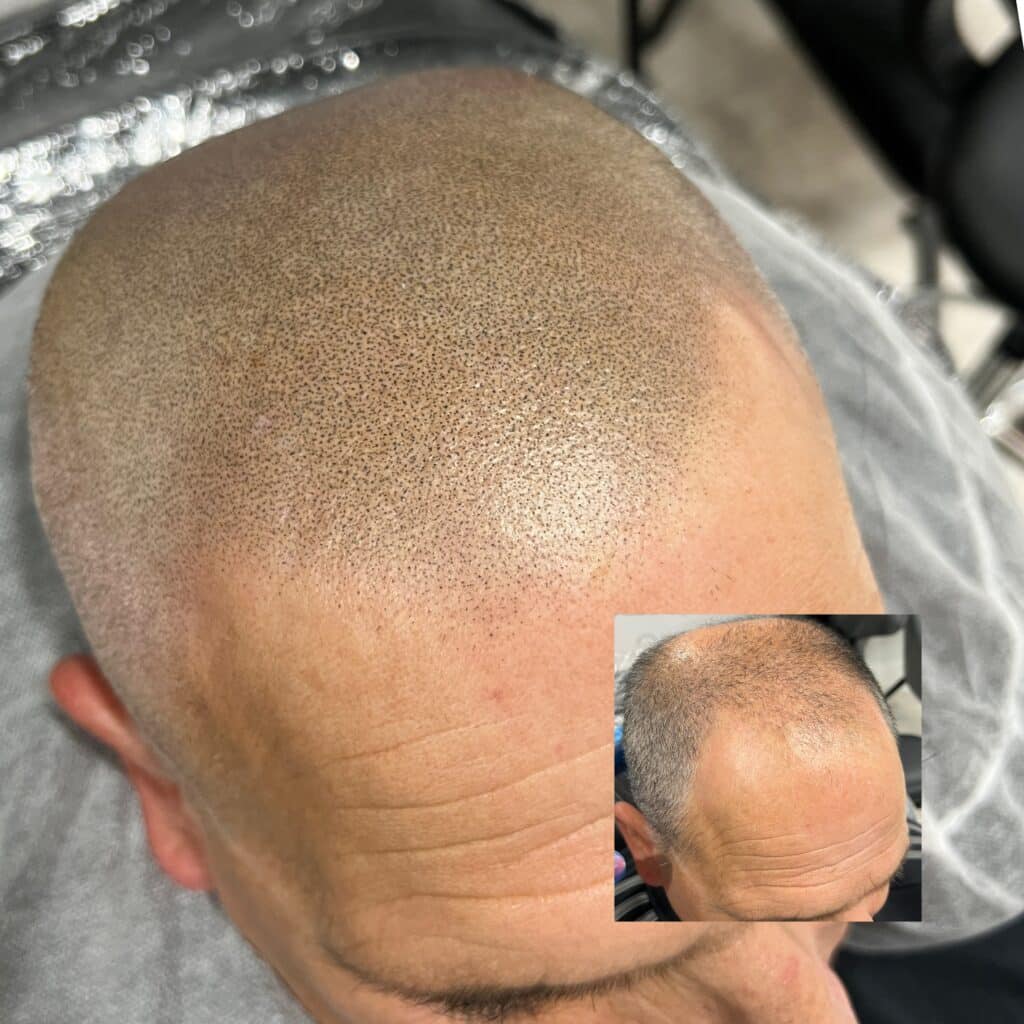 Close-up of soft feathered SMP hairline showing natural blending
