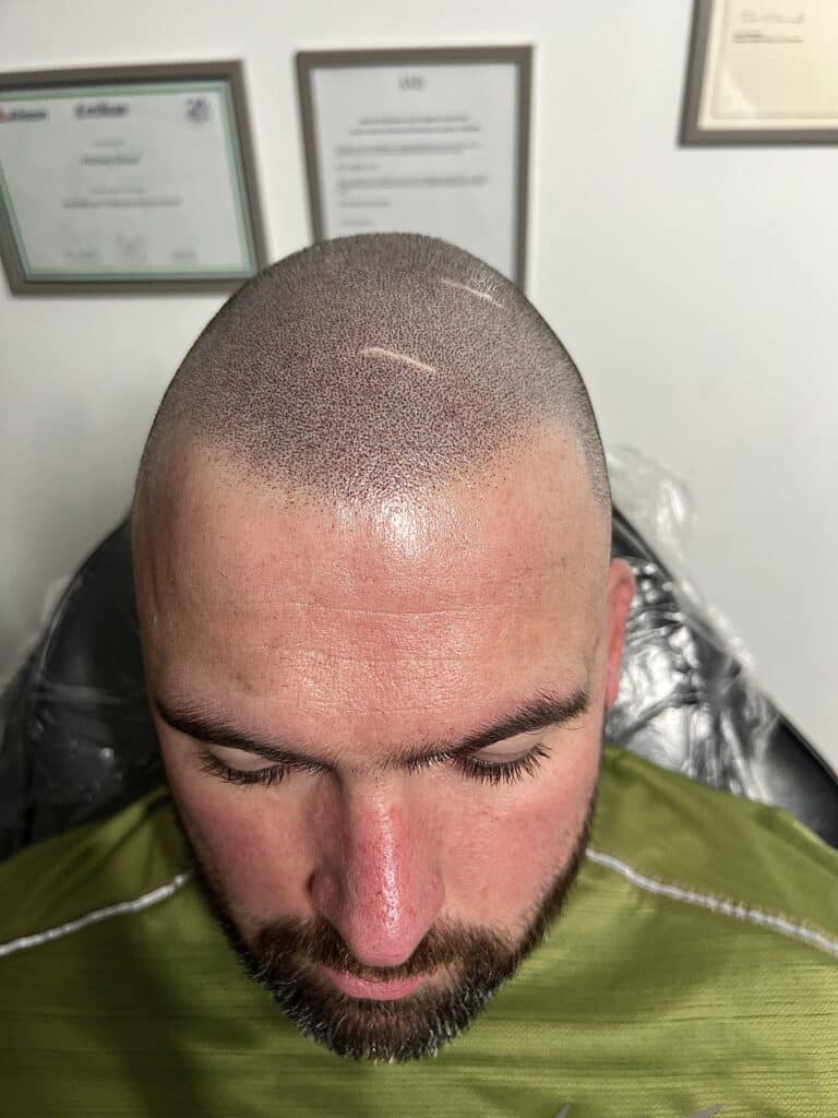 Natural SMP results by SMP-Clinic in Manchester using the Au-Natural Technique