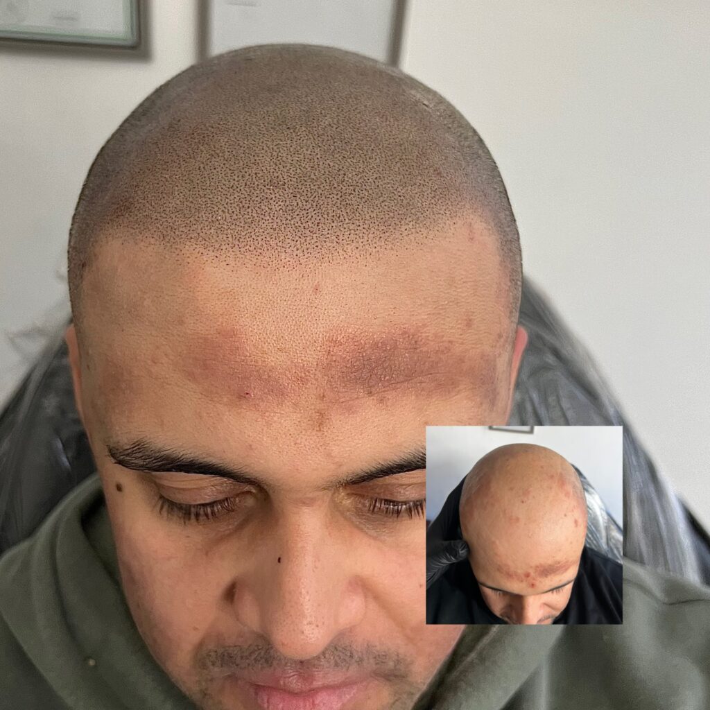 Scalp micropigmentation for alopecia before and after results