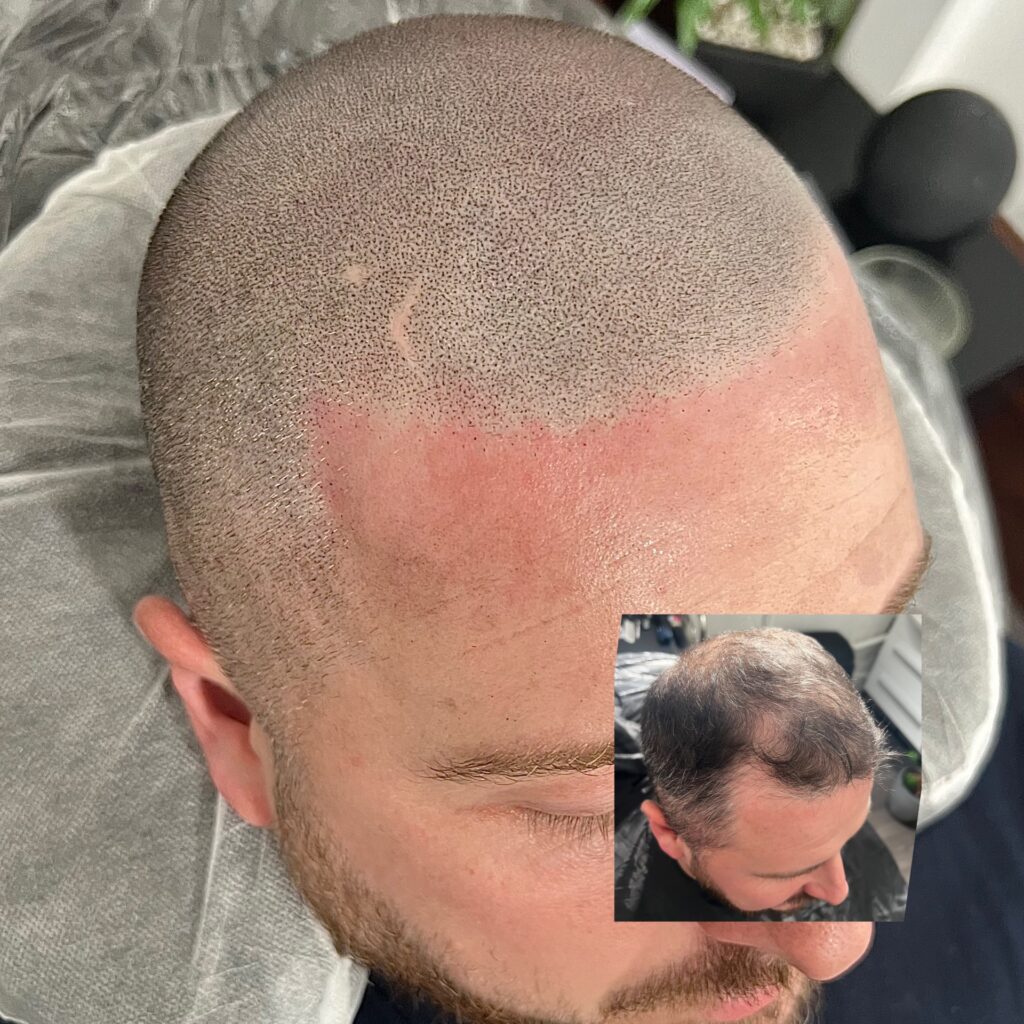 Before and after SMP treatment for receding hairline at SMP-Clinic Manchester
