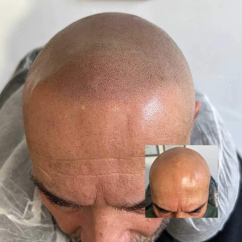Natural SMP result for receding hairline