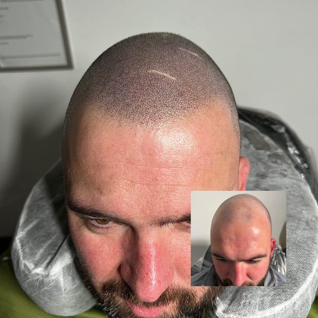 Client after SMP treatment showing fuller hair appearance