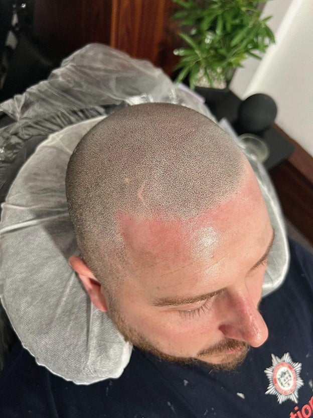 Man receiving scalp micropigmentation treatment for a receding hairline at SMP-Clinic & Training Academy in Stockport