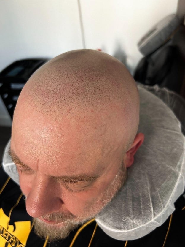 Client receiving natural scalp micropigmentation treatment using the Au-Natural Technique in Stockport
