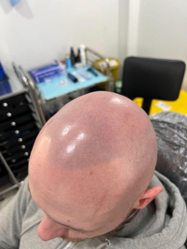 Natural hairline correction after bad SMP
