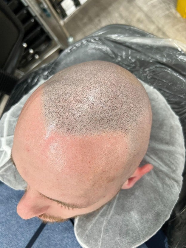 Natural hairline correction after bad SMP