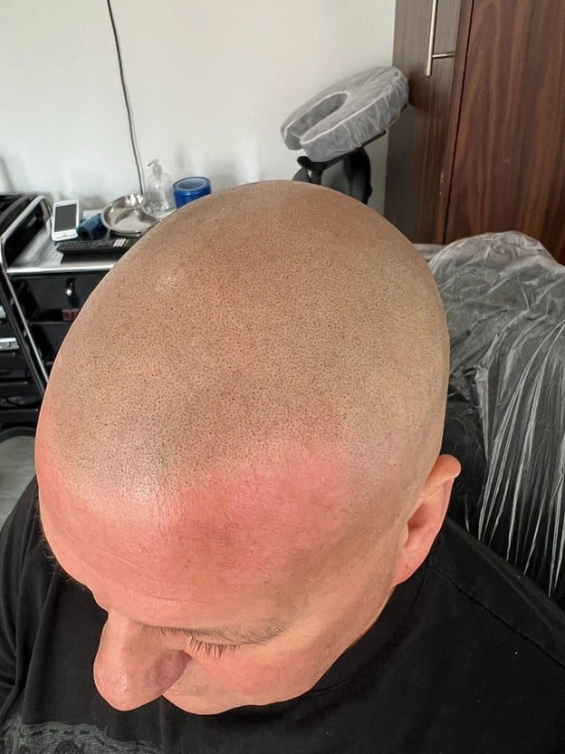 Side-by-side visual of scalp micropigmentation dot placement vs tattoo ink on skin, showing the difference in depth, pigment, and technique