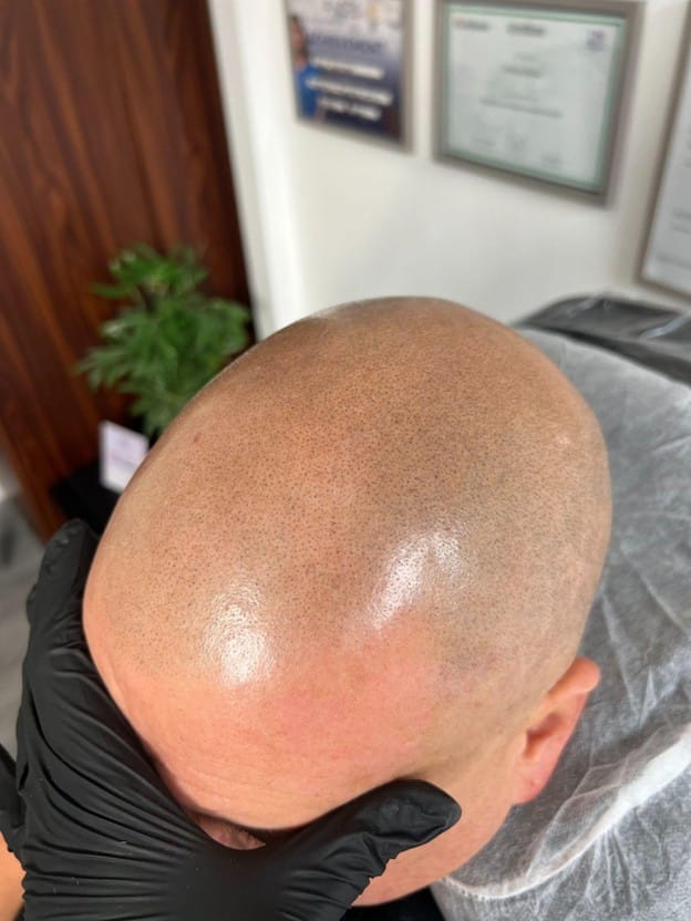Laser SMP removal before reapplication