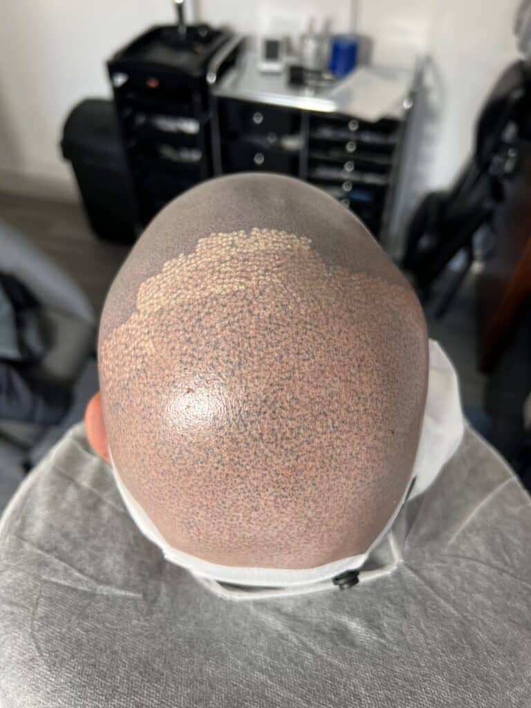 First SMP laser removal session in progress carried out by Ell and Nurse Rachel at SMP-Clinic Stockport.