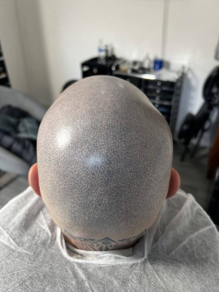 Before SMP removal showing dark, uneven scalp micropigmentation prior to laser treatment at SMP-Clinic Stockport.